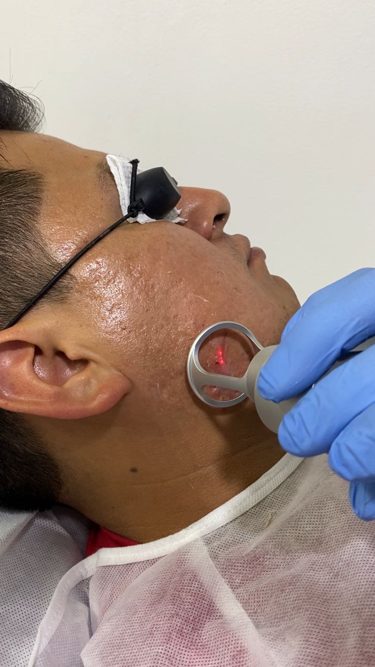 Tratamientos Estéticos acné laser 01