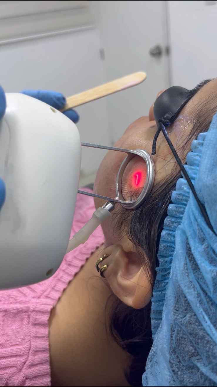 Tratamientos Estéticos acné laser 03
