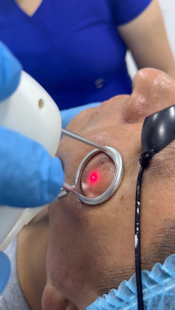 Tratamientos Estéticos acné laser 04