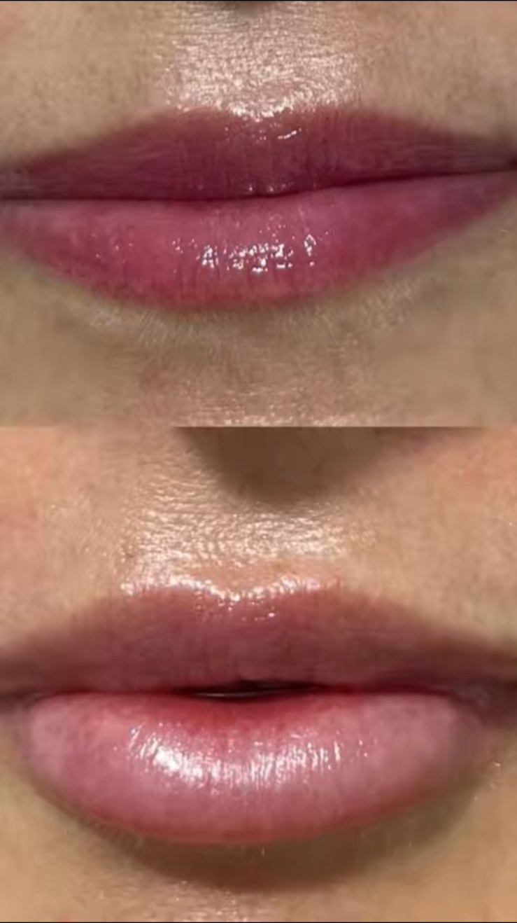 Tratamientos Estéticos aumento de labios 01