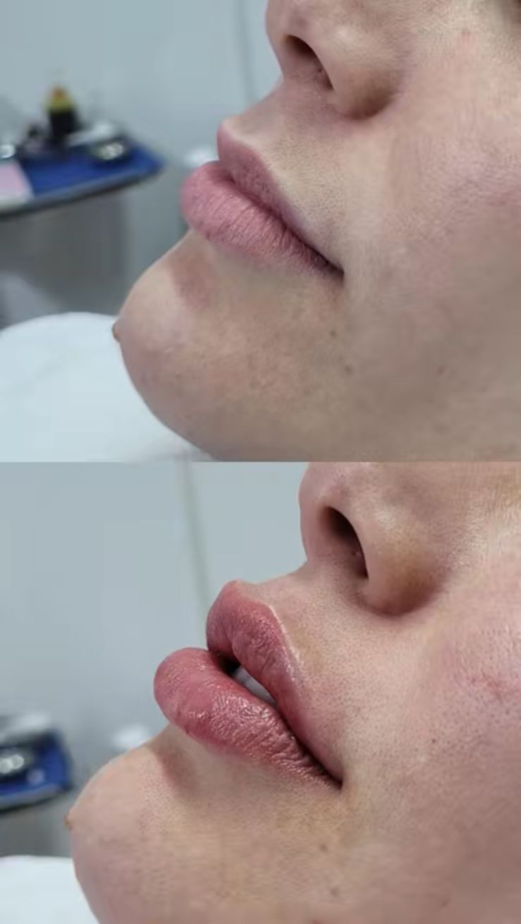 Tratamientos Estéticos aumento de labios 02