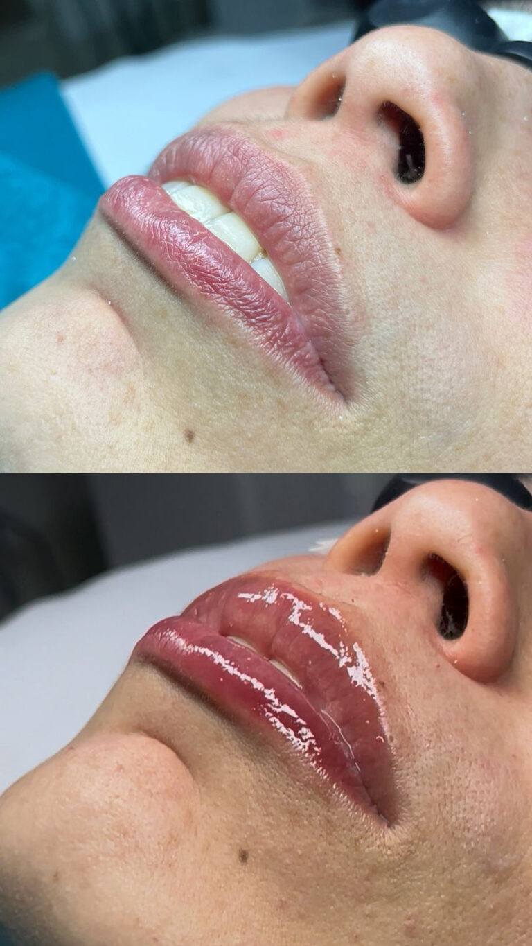 Tratamientos Estéticos aumento de labios 03