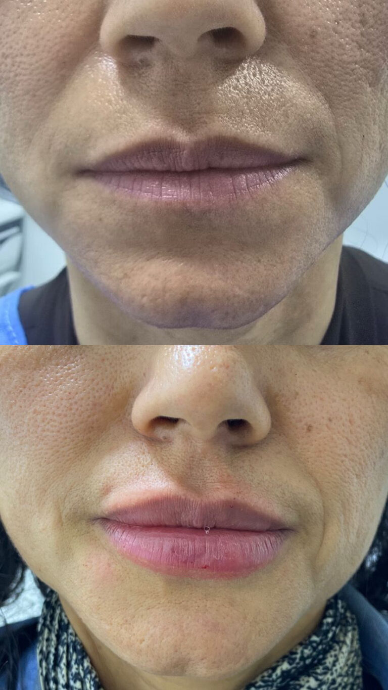 Tratamientos Estéticos aumento de labios 04