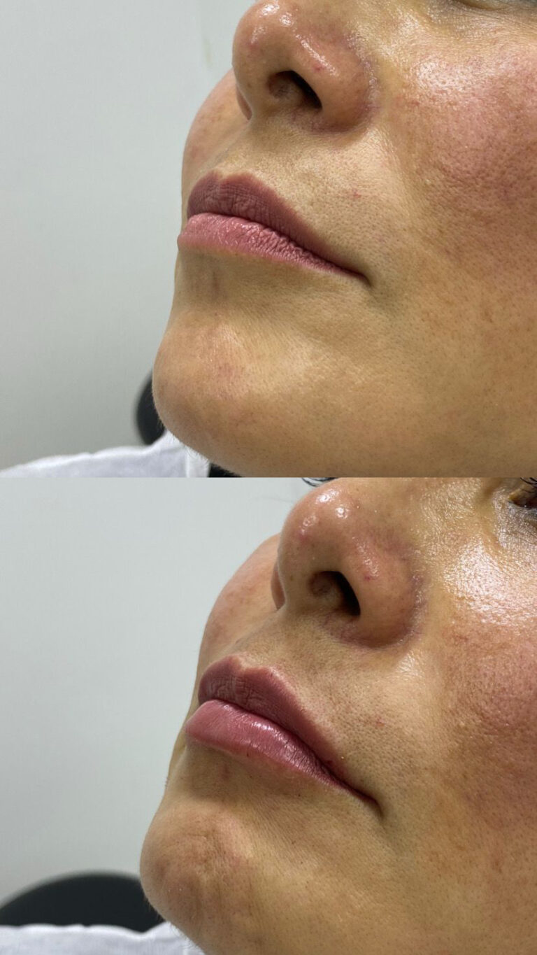 Tratamientos Estéticos aumento de labios 05