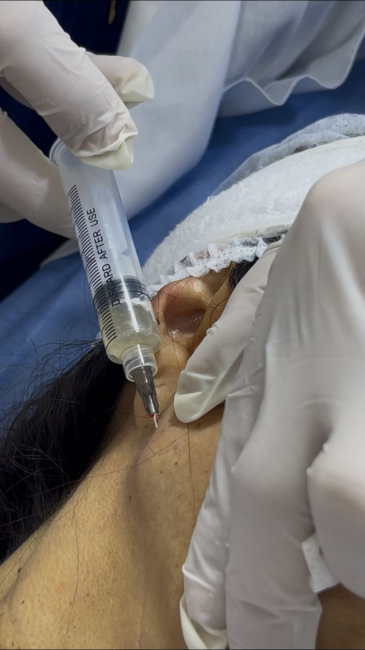 Tratamientos Estéticos bioestimuladores de colageno 01