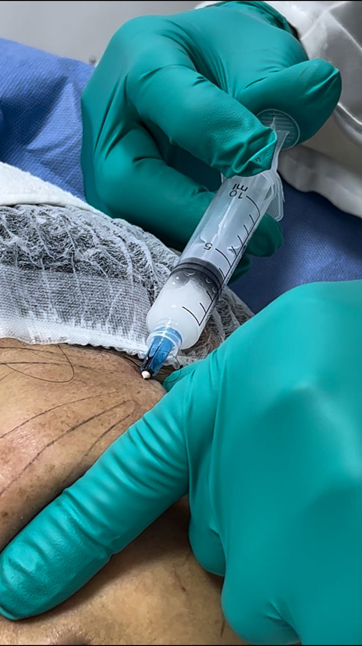 Tratamientos Estéticos bioestimuladores de colageno 04