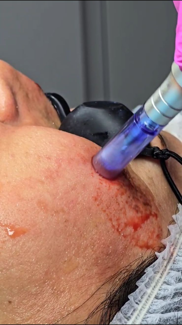 Tratamientos Estéticos dermapen 01