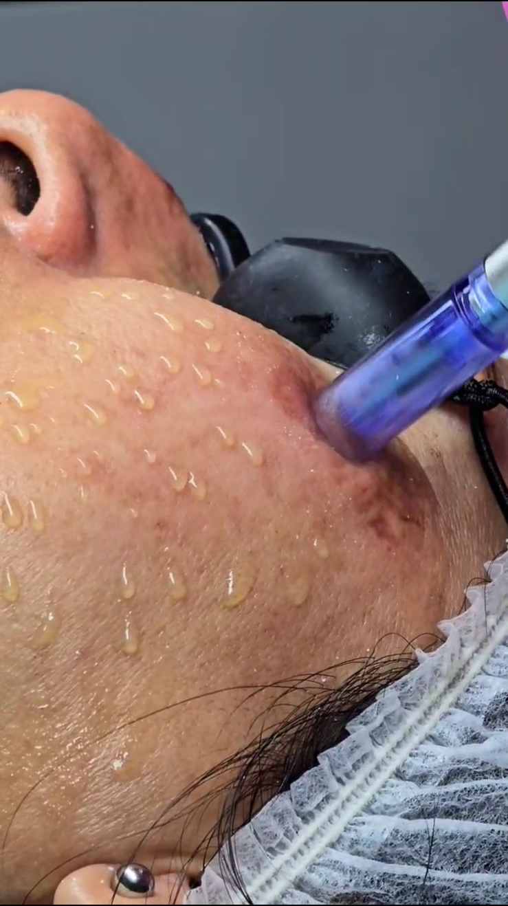 Tratamientos Estéticos dermapen 02
