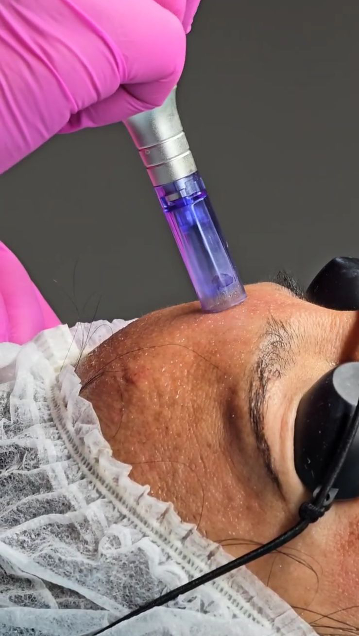 Tratamientos Estéticos dermapen 03