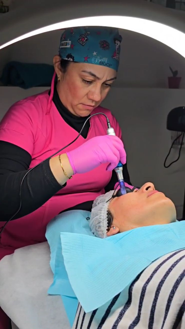 Tratamientos Estéticos dermapen 04