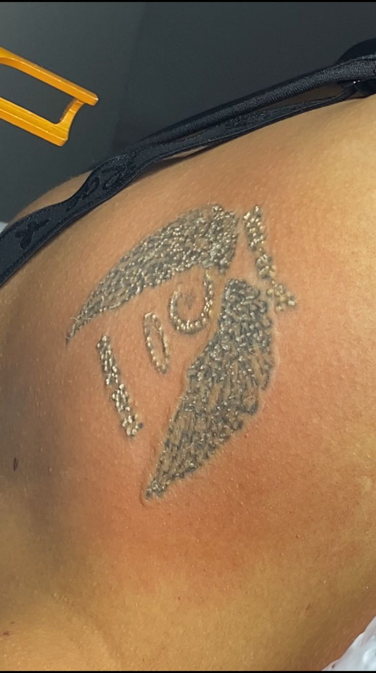 Tratamientos Estéticos eliminacion tatuajes 02