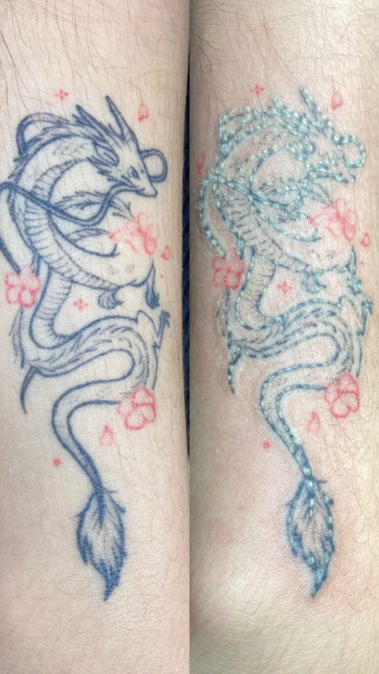 Tratamientos Estéticos eliminacion tatuajes 03