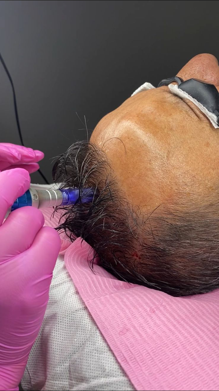 Tratamientos Capilares mesoterapia capilar 01