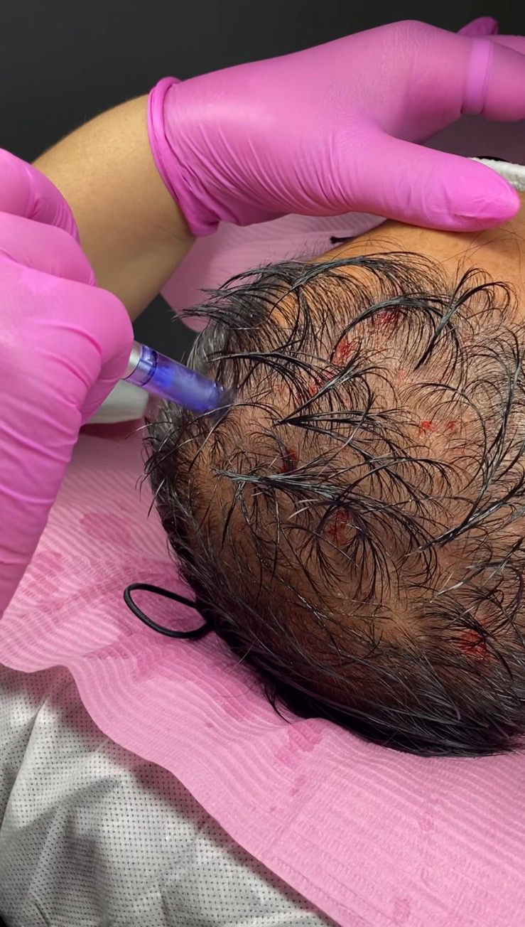 Tratamientos Capilares mesoterapia capilar 03
